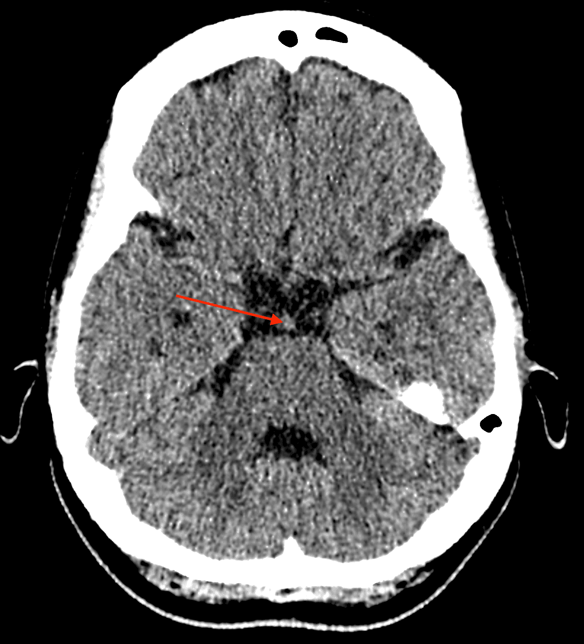 Real patient CT — name the arrowed structure
